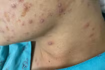 Nhiều bệnh nhân thủy đậu kiêng tắm bị biến chứng nguy hiểm tính mạng