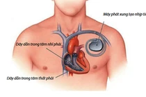 Lưu ý trong sinh hoạt sau cấy máy tạo nhịp tim