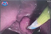 Cứu bệnh nhân u lớn đầu tụy làm biến dạng tá tràng