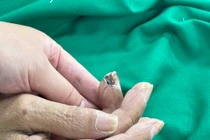 Từ vết thương nhỏ 10 trường hợp nguy kịch vì uốn ván: Cách gì phòng tránh