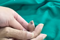 Từ vết thương nhỏ 10 trường hợp nguy kịch vì uốn ván: Cách gì phòng tránh