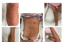 Bé gái 10 tuổi nổi ban toàn thân, không ngờ mắc bệnh hiếm