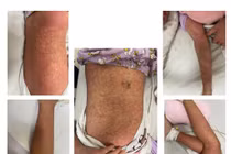 Bé gái 10 tuổi nổi ban toàn thân, không ngờ mắc bệnh hiếm