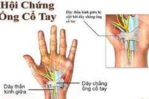 Cách chữa đau, tê, cứng cổ tay