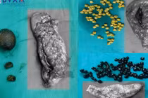 10% dân số mắc sỏi túi mật: Phòng ngừa cách nào