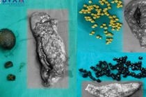 10% dân số mắc sỏi túi mật: Phòng ngừa cách nào