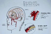 Bác sĩ chỉ rõ những rủi ro xảy ra đột quỵ ở người trẻ