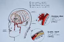 Bác sĩ chỉ rõ những rủi ro xảy ra đột quỵ ở người trẻ
