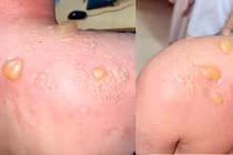 2 ca bỏng loét, hoại tử nặng vì tự ý điều trị tại nhà