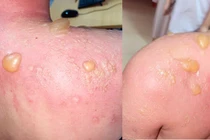 2 ca bỏng loét, hoại tử nặng vì tự ý điều trị tại nhà