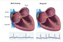 Rung nhĩ – nguyên nhân thầm lặng gây đột quỵ não