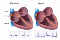 Rung nhĩ – nguyên nhân thầm lặng gây đột quỵ não
