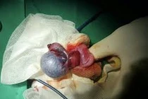 Đợi thi xong mới đi khám, thanh niên 22 tuổi phải cắt bỏ tinh hoàn