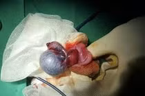 Đợi thi xong mới đi khám, thanh niên 22 tuổi phải cắt bỏ tinh hoàn