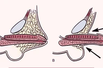 Bác sĩ mách cách phát hiện và điều trị vùi dương vật bẩm sinh ở trẻ