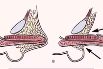 Bác sĩ mách cách phát hiện và điều trị vùi dương vật bẩm sinh ở trẻ