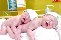 Cặp song sinh siêu nghịch: Một dây rốn thắt nút, một 3 vòng rau quấn cổ