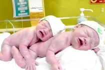 Cặp song sinh siêu nghịch: Một dây rốn thắt nút, một 3 vòng rau quấn cổ