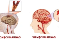 Trời lạnh... coi chừng đột quỵ, nhồi máu cơ tim