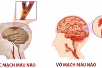 Trời lạnh... coi chừng đột quỵ, nhồi máu cơ tim