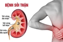 Những thói quen thường ngày là “hung thủ” gây sỏi thận