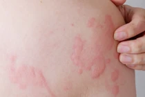 Bác sĩ chỉ rõ dị ứng, mày đay có phải do suy giảm chức năng gan?