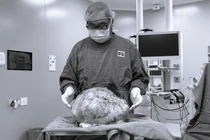 27 tuổi mang u hơn 16 kg, phẫu thuật bảo tồn chức năng sinh sản