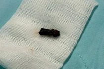 Bé trai 8 tháng suýt tử vong do hóc cuống trái xoài