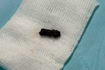 Bé trai 8 tháng suýt tử vong do hóc cuống trái xoài