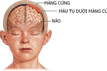 Sau tai nạn giao thông 2 tháng mới phát hiện tụ máu dưới màng cứng 