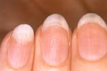 Những thay đổi ở móng tay biểu hiện cơ thể đang thiếu vitamin quan trọng
