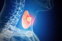 Hiểu về ung thư tuyến giáp để điều trị cho đúng