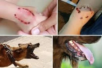 Người đàn ông lên cơn dại, tử vong sau 2 năm bị chó cắn