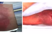 Cách gì phòng ngừa và chăm sóc da hoại tử do thoát mạch hóa chất?