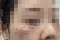  Nhiều người gặp tai biến vì làm đẹp bằng tế bào gốc