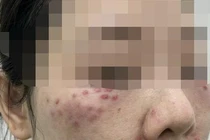  Nhiều người gặp tai biến vì làm đẹp bằng tế bào gốc