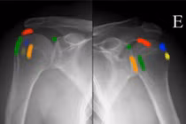 Bác sĩ chỉ cách chữa đau vai nhiều về đêm do viêm gân vôi hóa