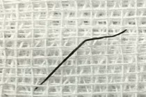 Nuốt ghim hồ sơ dài 2cm, cô gái 24 tuổi bị thủng ruột non