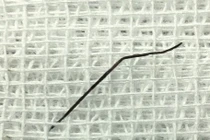 Nuốt ghim hồ sơ dài 2cm, cô gái 24 tuổi bị thủng ruột non