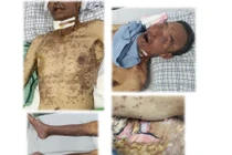 Loét toàn bộ da và niêm mạc do dị ứng thuốc với chứng hiếm gặp Stevens-Johnson/Lyell