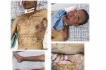 Loét toàn bộ da và niêm mạc do dị ứng thuốc với chứng hiếm gặp Stevens-Johnson/Lyell