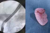 Đột ngột vàng da, vàng mắt... đi khám phát hiện sán lá gan trong bụng