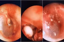 U tai giữa bẩm sinh: Không điều trị sớm... gây biến chứng nặng