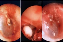 U tai giữa bẩm sinh: Không điều trị sớm... gây biến chứng nặng