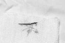 Nổi hạch tưởng ung thư... không ngờ do hóc xương cá