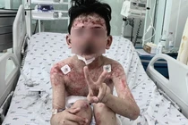 Sau 2 ngày ăn cua, bé trai 8 tuổi lở loét khắp người, nhiễm trùng nặng