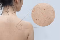 Đánh bay mụn lưng hiệu quả với 7 bước đơn giản