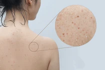 Đánh bay mụn lưng hiệu quả với 7 bước đơn giản