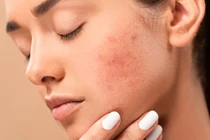 8 dấu hiệu nhận biết dị ứng mỹ phẩm, cần chú ý để chăm sóc da