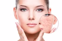 Cách chăm sóc và điều trị sẹo rỗ